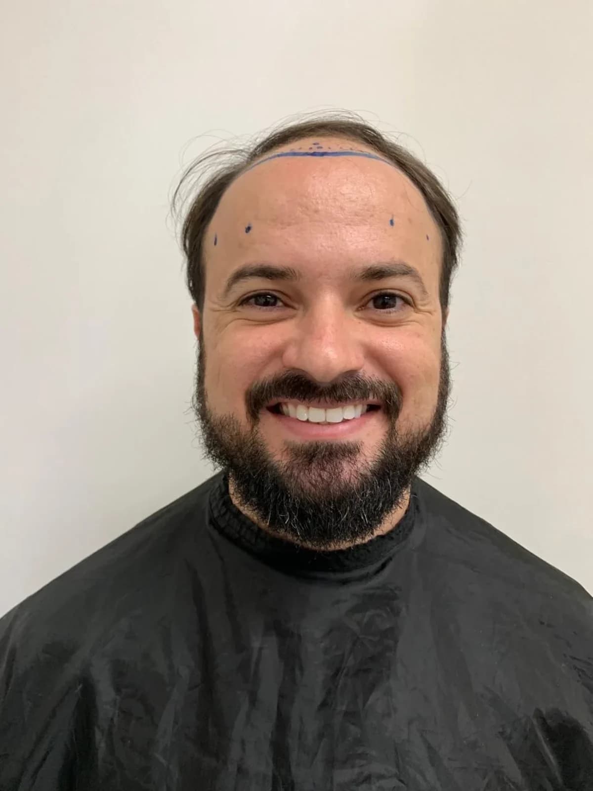 Paciente 1 antes do transplante capilar