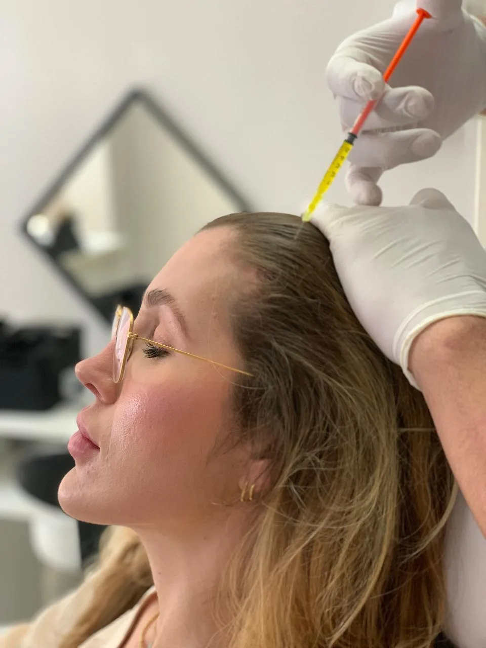 Aplicação de mesoterapia no couro cabeludo feminino